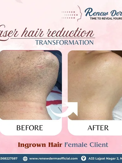 This is why I love what I do. We helped this client get rid of painful and persistent ingrown hair on her chin and neck area. The 'after' photo shows completely clear, smooth skin with no more irritation, a common result of our precise laser hair reduction treatment.