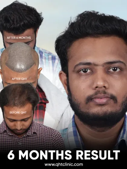 A 6-month result for our patient Ayush. His dense new hair is a story of newfound confidence.