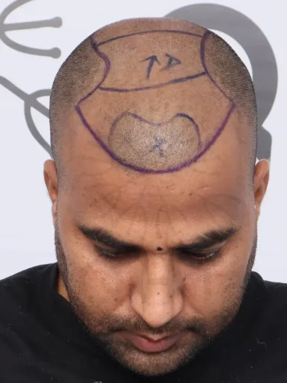 This shows the crucial first step: hairline design. We mark the area precisely to ensure the final result perfectly frames the face.