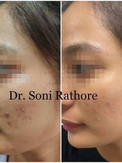 This image, taken two weeks into an acne treatment plan, demonstrates a visible reduction in inflammation. Consistency from the very beginning is what sets the stage for long term clear skin.