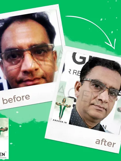 A before and after transformation showcasing the excellent results of our advanced Biotech FUE method, delivering a natural and youthful appearance.