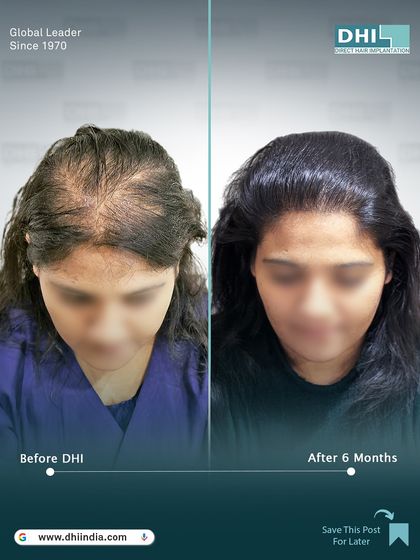A top-down view of a 28-year-old female client 6 months after her procedure. With 2,942 hairs implanted using our no-shave technique, the transformation in density and coverage is remarkable.