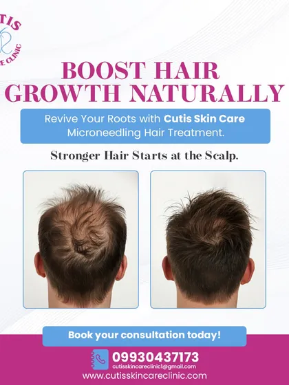 A before and after view from the back of a patient's head, showing the results of our microneedling hair treatment. The image on the left shows visible thinning at the crown, while the image on the right displays noticeably thicker and denser hair growth.