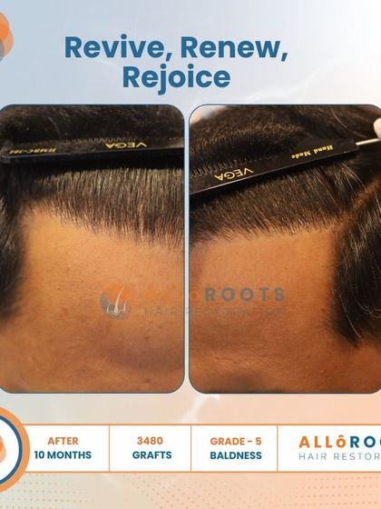 Revive, Renew, Rejoice. This 10-month result for a Grade 5 baldness case, using 3480 grafts, shows a complete restoration. The images from all angles prove that a full head of hair is an achievable goal.