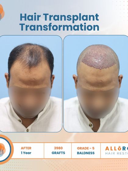 A one-year transformation for a Grade 5 baldness case using 3980 grafts. The images show the before, the immediate post-op, and the final result, demonstrating the entire process and its successful outcome.