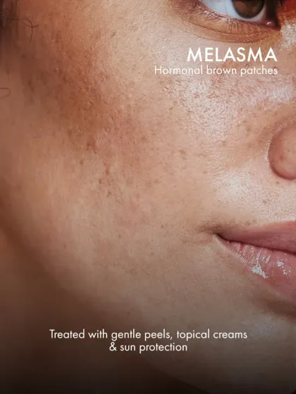 Melasma appears as hormonal brown patches on the skin. I treat it with a careful combination of gentle peels, specialized topical creams, and strict sun protection protocols.
