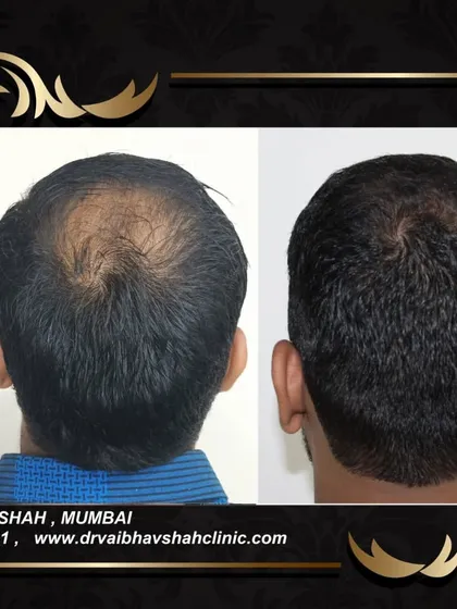Another successful crown coverage result. The natural pattern of hair growth has been restored, making the transplant completely unnoticeable.