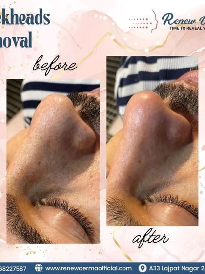 A clear and satisfying before-and-after of a blackhead removal treatment. With just one session, you can see a significant improvement, resulting in smoother, clearer skin on and around the nose.