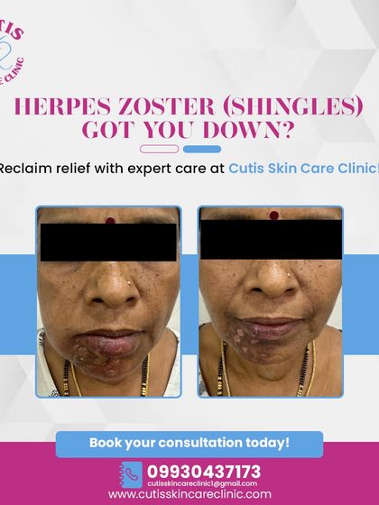 This before and after image shows the healing progress of a patient with Herpes Zoster (Shingles) around the mouth. Our personalized care provides soothing relief and promotes faster healing from this painful condition.
