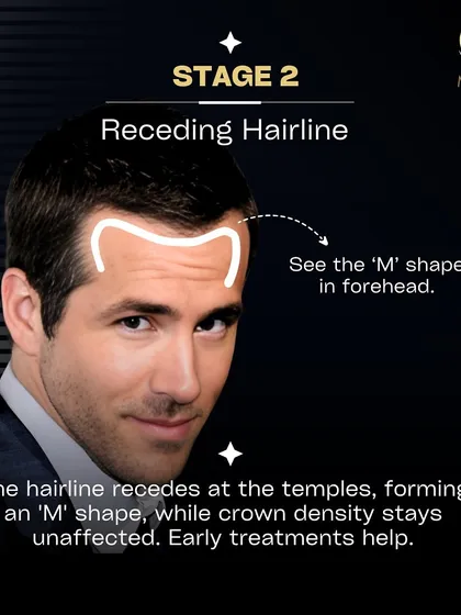 In Stage 2, the hairline recedes at the temples, forming a distinct 'M' shape. The crown density is usually unaffected, and early treatments can help slow down progression.