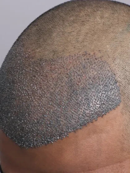 The beginning of a transformation for a Diffuse Grade 4a patient. 3400 grafts were placed to recreate the hairline and restore the frontal and mid-scalp.