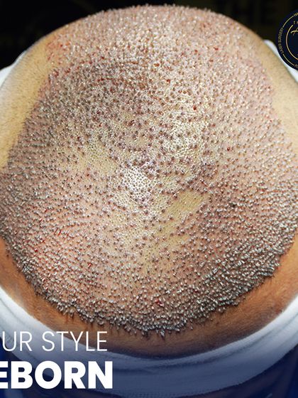 This is where science meets style. A detailed view of newly implanted hair follicles, showcasing the meticulous process of high-density hair restoration.