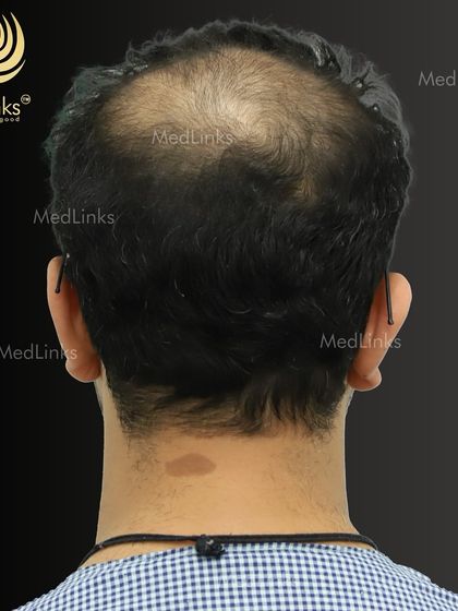 The thinning crown area is clearly visible in this 'before' shot.