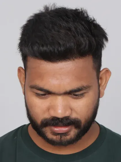 A 10-month transformation for a patient with diffuse pattern baldness. With 2400 grafts, we restored his look and confidence.