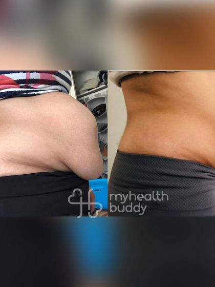 This client not only lost fat but also healed her Diastasis Recti gap. Her measurements show a significant reduction in the gap's width and depth, proving that targeted exercises can make a real difference in postpartum recovery.