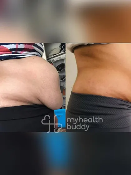 This client not only lost fat but also healed her Diastasis Recti gap. Her measurements show a significant reduction in the gap's width and depth, proving that targeted exercises can make a real difference in postpartum recovery.