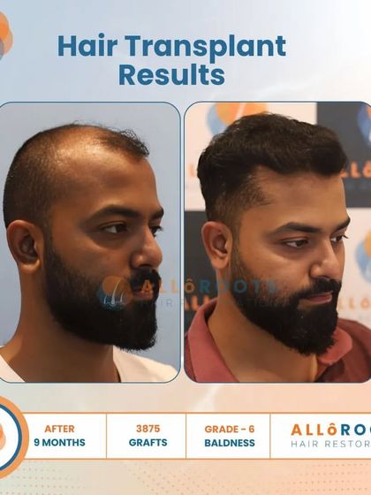 This 9-month result for a Grade 6 baldness case, achieved with 3875 grafts, is a testament to what is possible even in advanced stages of hair loss. The transformation is comprehensive and natural.