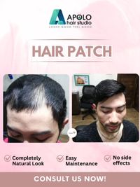 Non-Surgical Hair Replacement