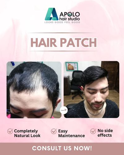 Non-Surgical Hair Replacement