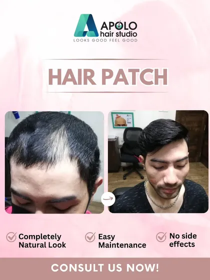 This client was concerned about thinning on top. Our hair patch provided a completely natural look with no side effects and is easy to maintain, giving him a fresh, confident appearance.