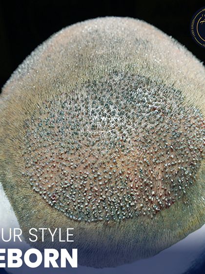 This is where science meets style. A detailed view of newly implanted hair follicles, showcasing the meticulous process of high-density hair restoration.