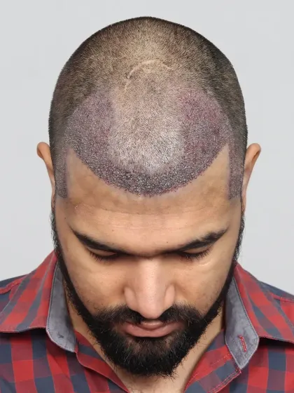 This is what a scalp looks like immediately after the procedure. Each dot is a carefully placed graft, the foundation of a future full head of hair.