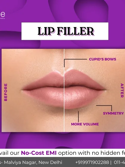 A look at the beautiful, natural-looking results of our lip filler treatment. This before and after comparison highlights how we enhance volume, define the cupid's bow, and create better symmetry for a balanced and confident smile. Our goal is always to enhance your unique features.