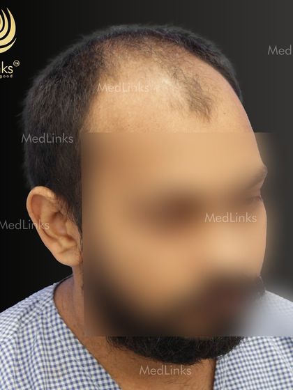 A side view of the patient's hair loss before the procedure.