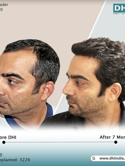 Another side-profile view of the 7-month transformation. The natural angle and direction of the implanted hair are evident, showcasing the precision of the DHI technique.