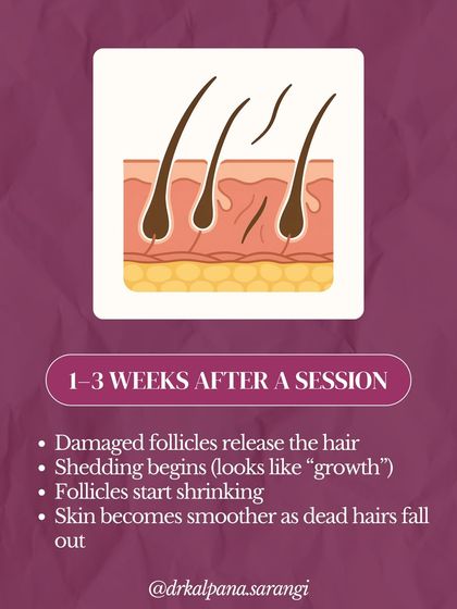 In the 1 to 3 weeks following a treatment, the damaged follicles begin to release the hairs. This shedding process can sometimes look like new growth, but it is actually the treated hairs falling out. As they shed, the skin becomes progressively smoother.