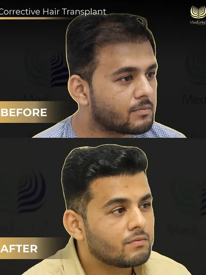 The side profile of this corrective case shows how we not only added hair but also redesigned the hairline for a much more natural and balanced appearance. Second chances deserve first-class results.