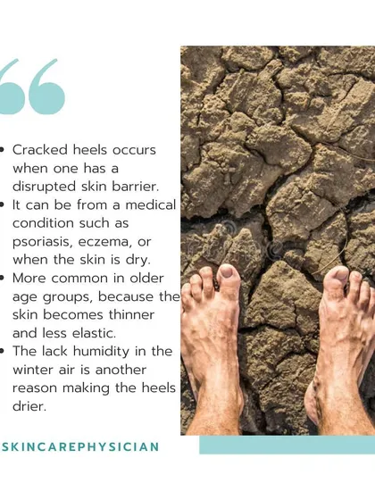 Cracked heels occur when the skin barrier is disrupted, often due to dry skin, medical conditions like eczema, or simply the lack of humidity in the winter air.