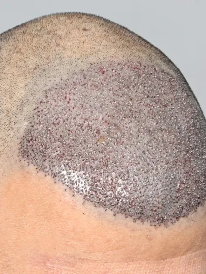 Saying goodbye to baldness. 3500 grafts placed to restore the hairline and mid-scalp.