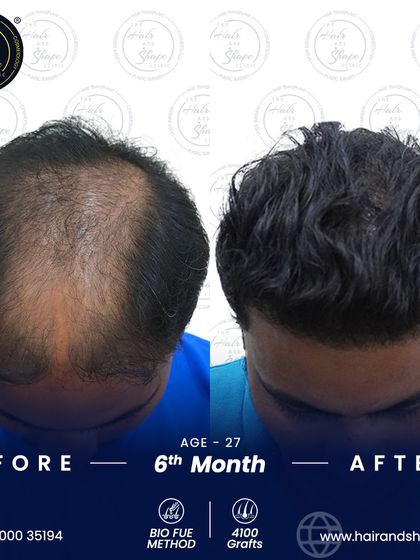 A 6-month progress shot of a 4100-graft BIO FUE procedure, showing significant new growth and density across the top of the scalp.