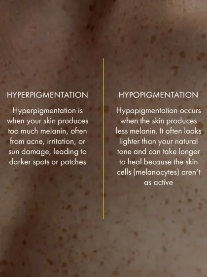 This infographic clearly defines the difference between hyperpigmentation (too much melanin, causing dark spots) and hypopigmentation (too little melanin, causing light patches).