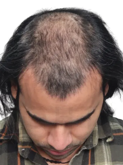 A 14-month transformation for a Diffuse Grade 5A case. We used 4200 grafts to recreate the hairline and re-densify the frontal and mid-scalp.