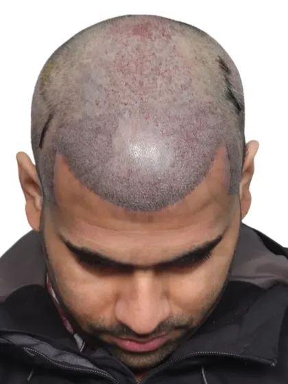 The post-surgery view of a 4200 graft procedure, showing the newly implanted hairs that will grow into a full look.