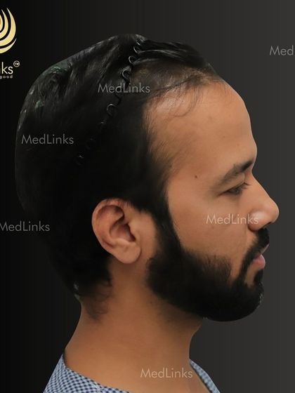 The patient's hair from the side before the procedure.