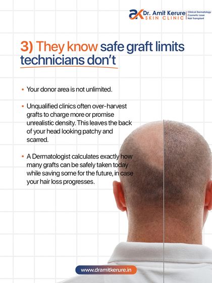 Your donor area is a limited resource. Unqualified clinics often over-harvest grafts, leaving the back of your head patchy. I calculate exactly how many grafts can be safely taken while preserving your donor area for the future.