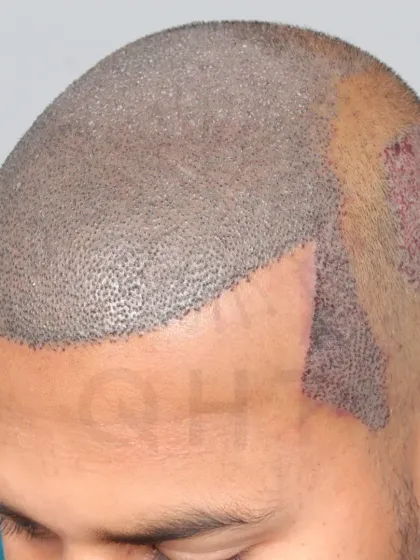 A Diffuse Grade 5A transformation begins with 5850 grafts. We recreated the hairline, frontal part, mid-scalp, and temples.