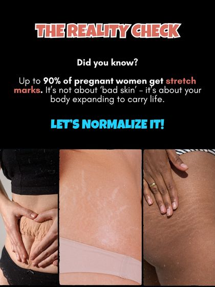 The reality is that up to 90% of pregnant women get stretch marks. It is not about "bad skin," it is about your body expanding to carry life. Let's normalize it.