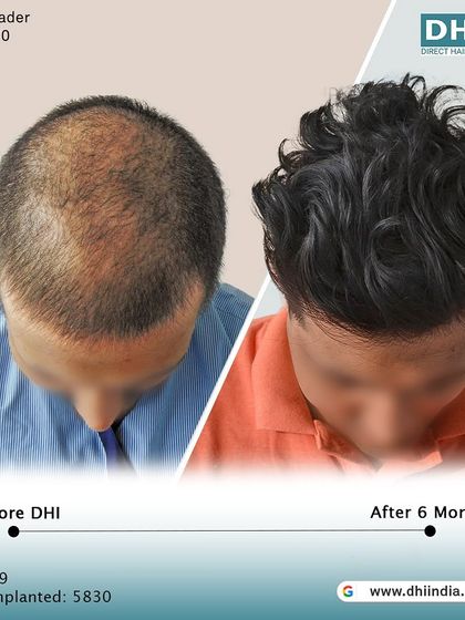 A top-down view of a 29-year-old client 6 months after his procedure. With 5,830 hairs implanted, the transformation in density and coverage is already outstanding.