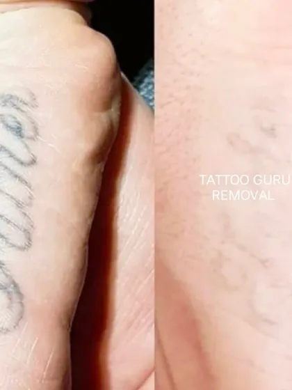 Another example of a name tattoo removal from the hand. The final result shows smooth skin where the script tattoo used to be.