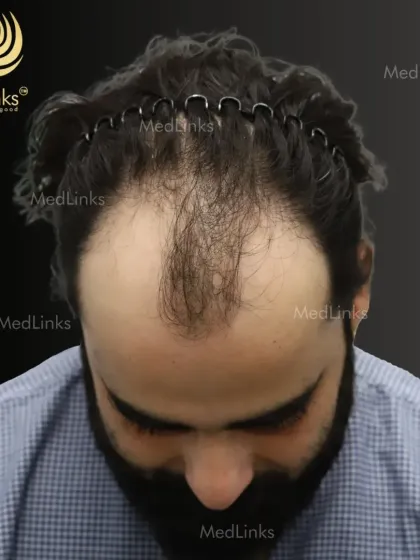 A top-down view before the procedure, which we use to plan the placement of each graft for maximum density.