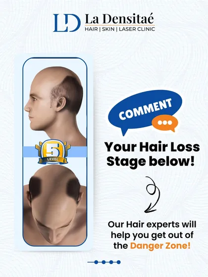 This image focuses on Stage 5 of hair loss, a point where you are in the "Danger Zone." I encourage users to comment with their stage so my expert team can guide them toward the best solution.
