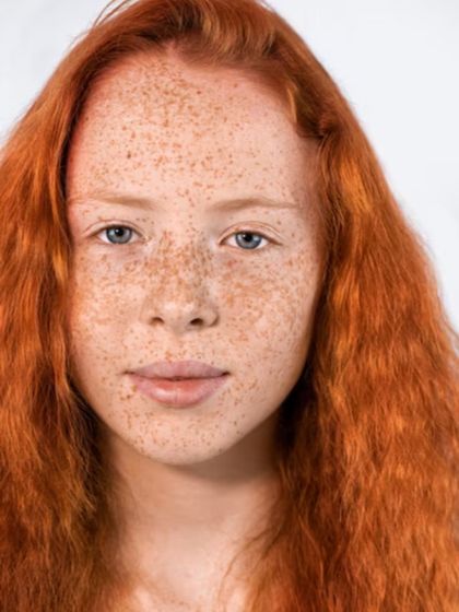 Freckles and lentigines, often caused by sun exposure, can be effectively lightened with laser treatments. My goal is to create a more even and uniform skin tone while maintaining a natural look.