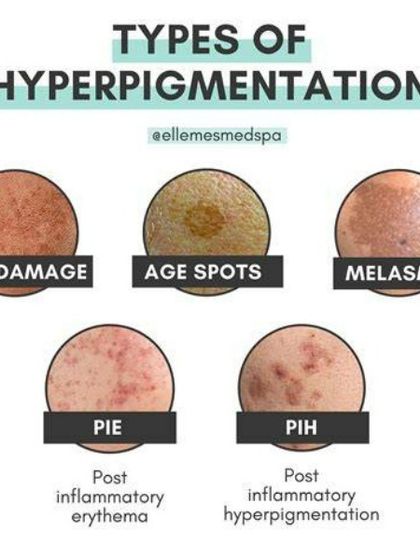 This graphic explains the different types of hyperpigmentation I treat, from sun damage and age spots to melasma and post-inflammatory marks. A correct diagnosis is the first step to effective treatment.