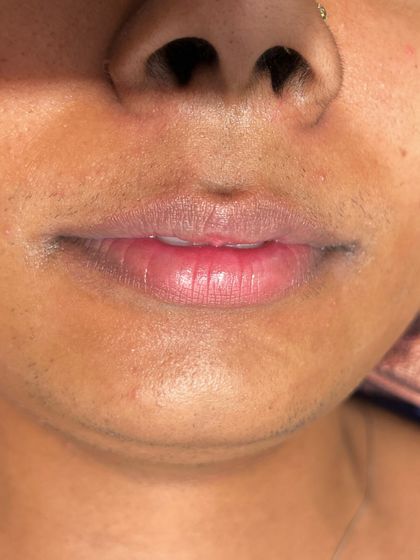 A close-up of the lip area before a lip blush treatment. This client had some darkness and uneven tone she wanted to correct.