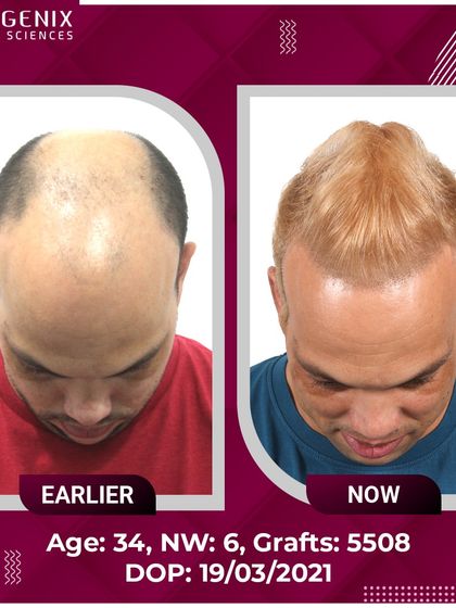 The full head hair transplant results for an international patient, showcasing a complete change with 5508 grafts.