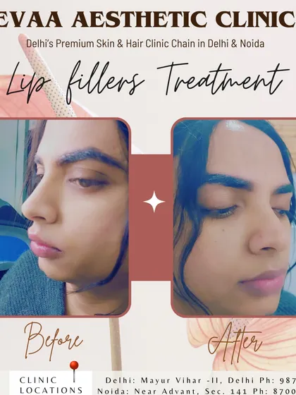This before-and-after image highlights a natural-looking lip filler transformation. We focused on enhancing the client's lip volume and shape for a balanced and aesthetically pleasing result that complements their facial features.